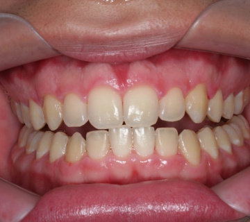 clareamento_dental_01