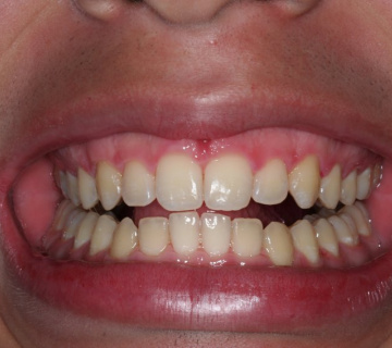 clareamento_dental_02