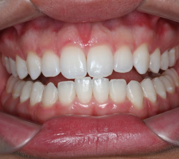 clareamento_dental_03