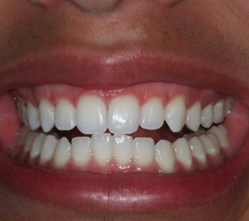 clareamento_dental_04