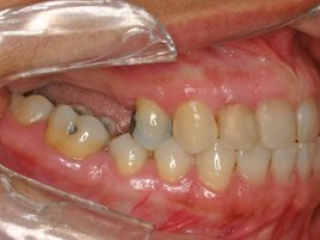 enxerto-de-seio-maxilar-01