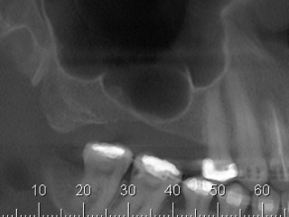 enxerto-de-seio-maxilar-02