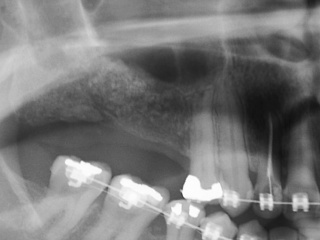 enxerto-de-seio-maxilar-03