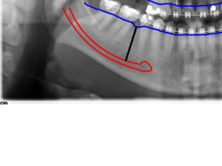 enxerto-de-seio-maxilar-04