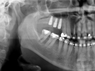 enxerto-de-seio-maxilar-05